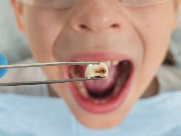 Best Emergency Dental Extractions in Smith Mills, MA